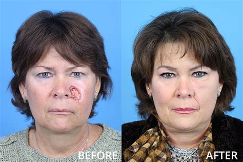 Before And After Facial Plastic Surgery Center Washington