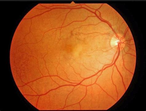 Pseudoxanthoma Elasticum Effects On The Eye Ophthalmology Education