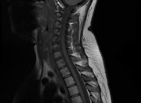 Osteoid Osteoma Spine Image