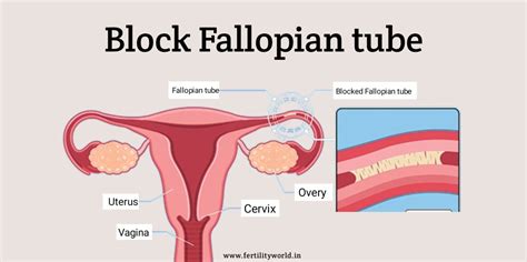 Blocked Fallopian Tube Fertilityworld