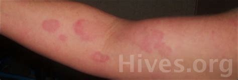What Hives Look Like Baby Center