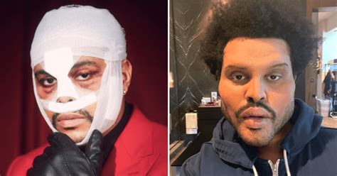 Paulo nunes • 116 тыс. Did The Weeknd get plastic surgery? Truth behind botox ...