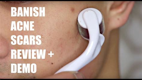 Acne Scar Removal Banish Acne Scars Demo Review Youtube