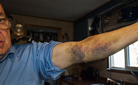 Ct Scan Brings Intense Pain Bruising And An Apology Cbc News