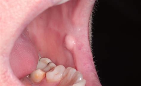 Fibroma Na Mucosa Bucal Otosection