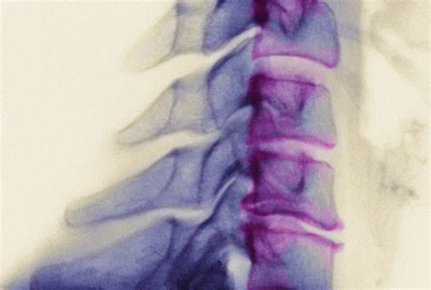 Arthritis In The Neck — Cervical Spondylosis