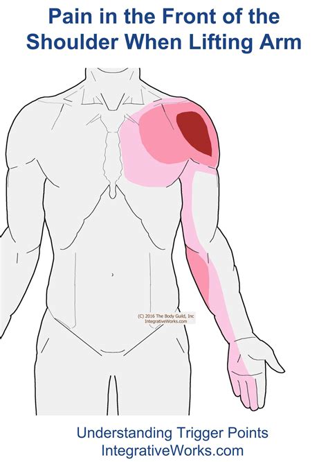 Pain distribution, severity and type of pain were recorded by the patients on a pain diagram. Front of shoulder pain when raising arm | Integrative Works