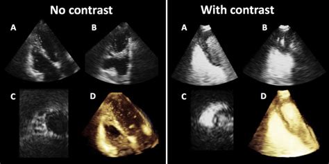 Quantification Of Right Ventricular Size And Function From Contrast