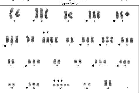 Routine Cytogenetic Analysis Of Chromosome Abnormalities In Acute Lymphoblastic Leukemia