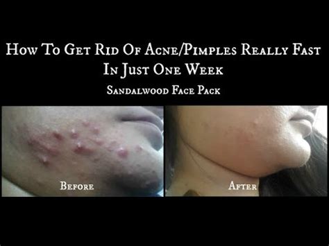 Check spelling or type a new query. How to get rid of Acne or Pimples in just 1 week| Acne ...