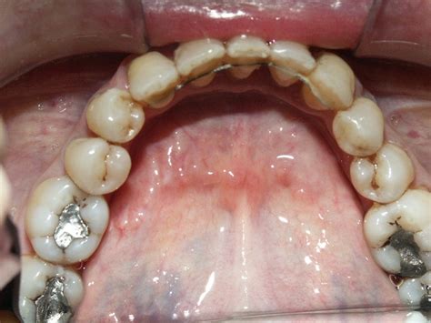 Caso 12 Paciente Periodontal Paciente Con Piorrea