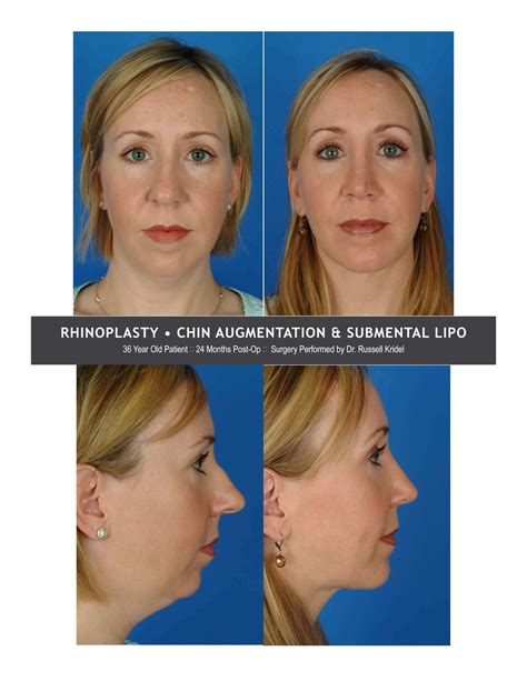 Chin Implant Surgery Trending Up Chin Implant Surgery Trending Up