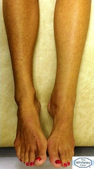 Hidden Varicose Veins With Swollen Leg Not Lymphoedema