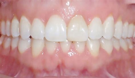 Invisalign Treatment System Orthodontic Invisalign Provider