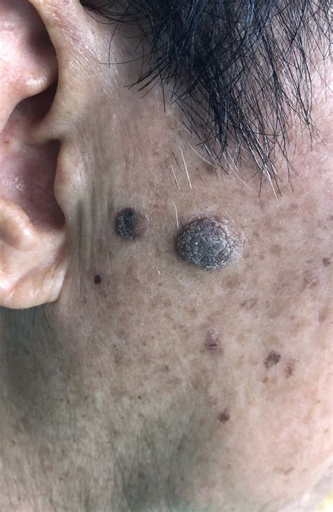 How To Remove Seborrheic Keratosis And What Should I Expect During Removal Photo Human