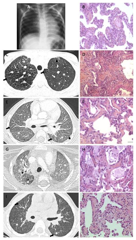 Interstitial Lung Disease Histology