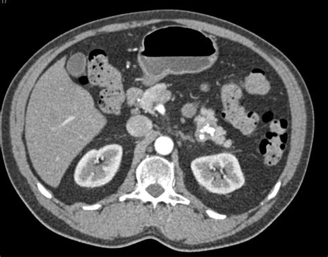 Serous Cystadenoma Of The Pancreas With Calcification Pancreas Case