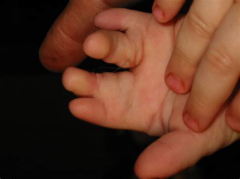 Poland syndrome refers to a congenital unilateral absence of the pectoralis major and minor muscles and is a recognized cause of unilateral hyperlucent hemithorax. Poland Syndrome