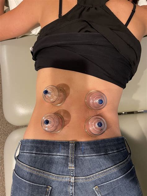 What To Expect With Cupping Therapy