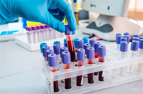 New Blood Test Detects Cancer In Early Stages Ratemds Health News