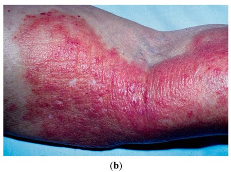 Jof Free Full Text Cutaneous Protothecosis In A Patient With