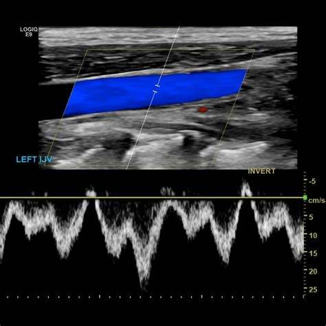Upper Extremity Venous Doppler Sonographic Tendencies Vascular Ultrasound Ultrasound Vein