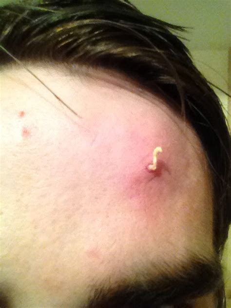 Had This Lump On My Forehead Years Thinking It Was A Wart Moved To The