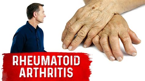 Use These Spices And Herbs For Rheumatoid Arthritis Remedies For