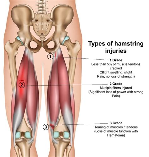 Differentiation Of Hamstring Tendonitis And Strains Vs Hamstring Syndrome