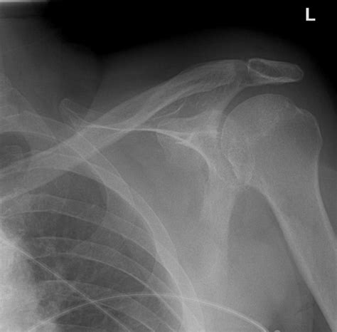 Fractura De Acromion Cauze Diagnostic Tratament