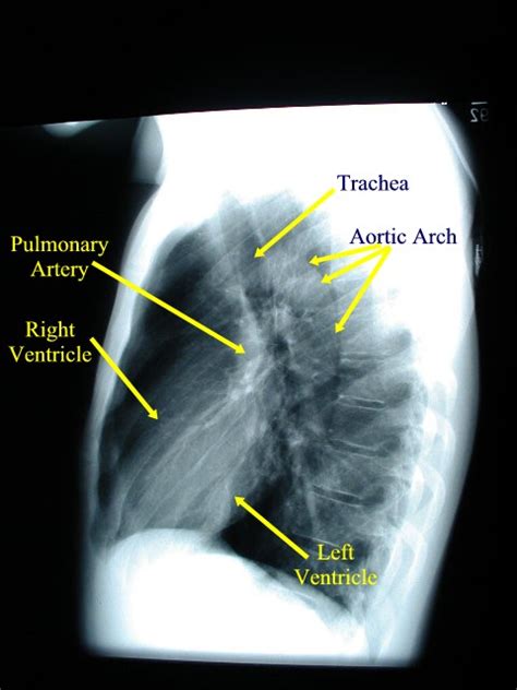 Labeled chest radiographs teaching radiologic anatomy with a level of detail appropriate for medical students. Chest X-ray
