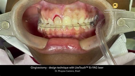 Gingivectomy Design Technique With Litetouch™ Eryag Laser Youtube