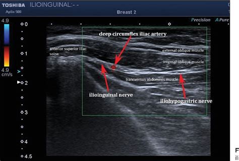 Figure 1 From Selective Spinal Nerve Block In Ilioinguinal