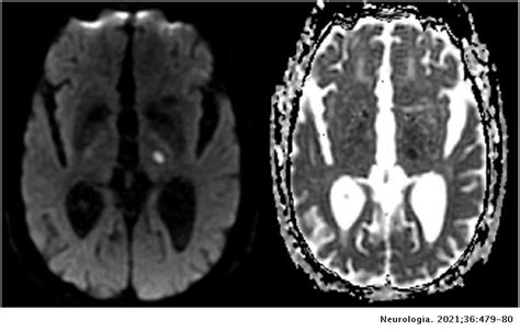 Wrong Way Deviation Due To Thalamic Ischemic Stroke A New Association