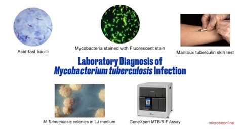 Laboratory Diagnosis Of Mycobacterium Tuberculosis Infection Learn