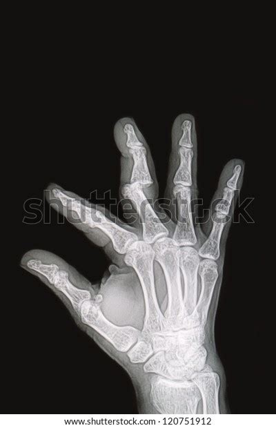 Wrist Hand Xrays Image Show Fracture Stock Photo Edit Now 120751912