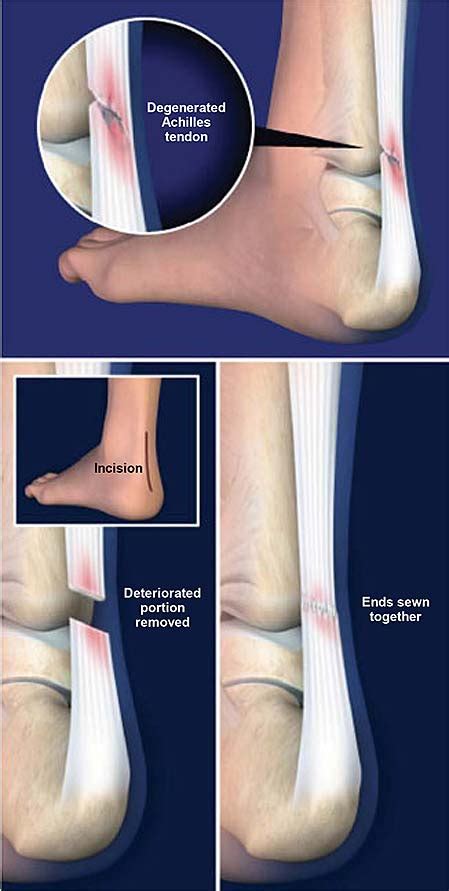 Debridement Of The Achilles Tendon Central Coast Orthopedic Medical Group