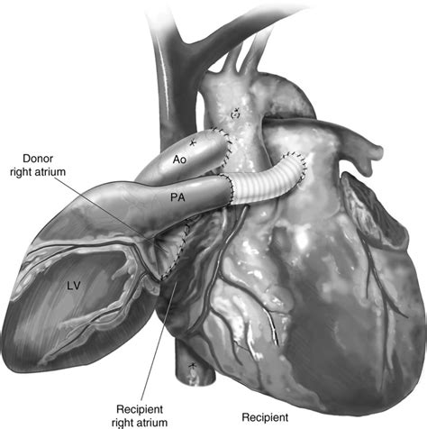 Heterotopic Heart Transplantation Technical Considerations Operative