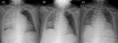 The Serial Chest Radiographs Taken After Initiation Of Treatment A