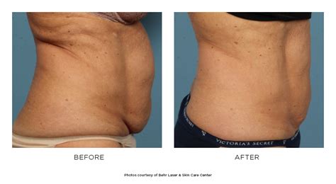Coolsculpting® Elite Before And After Photos Behr Laser And Skin Care Center