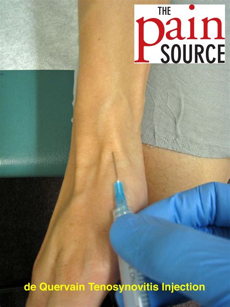 De Quervains Tenosynovitis Injection Technique And Tips The Pain