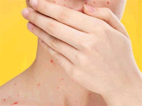 Can You Have Chickenpox Spots Inside Your Mouth Disease Knowledge