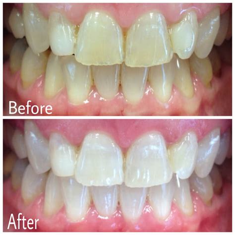 4 best teeth whitening options 10.5 how long does teeth whitening last? Teeth Whitening — LAKEBRINK DENTAL :: Liberty MO Dentist