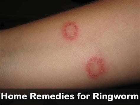 How To Get Rid Of Old Ringworm Scars Howtoremvo