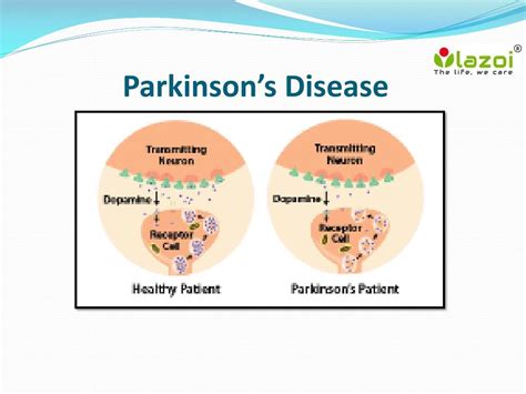 Ppt Parkinsons Disease Overview Symptoms Causes Treatment And Diagnosis Powerpoint