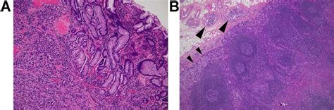 Histology Of The Primary Gastric Cancer A Note That Highly Atypical