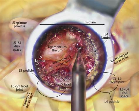 The ligamentum flavum consists of a superficial and a deep component. Minimally Invasive Laminectomy | Neupsy Key