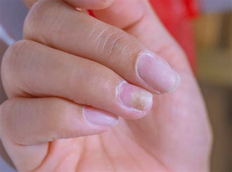 How To Treat Common Nail Problems Step To Health
