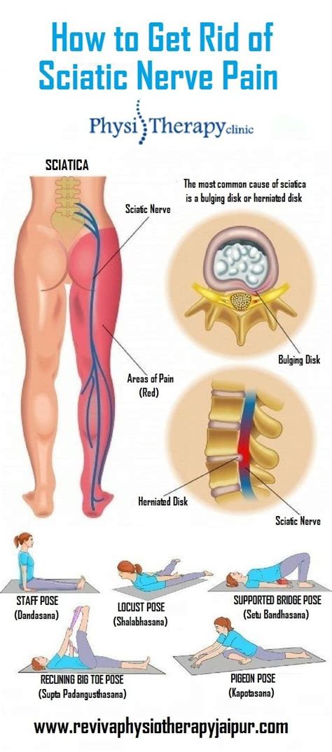 Pin On Sciatic Nerve Pain