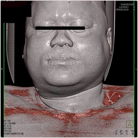 Thyroid Goiter Neuro Case Studies Ctisus Ct Scanning